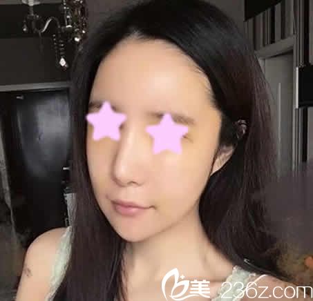 我在太原歐美蓮做面部自體脂肪填充術(shù)后第3天照片