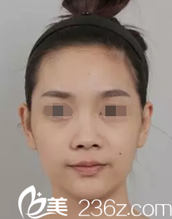 術(shù)前面部顴骨高塌鼻梁 術(shù)前面部顴骨高塌鼻梁