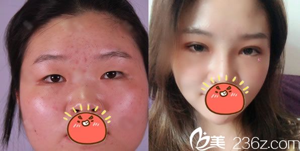 寧波珀悅金式倫做雙眼皮<span style= 寧波珀悅金式倫做雙眼皮<span style=