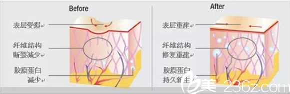 DNA活細(xì)胞煥膚術(shù)肌膚示意圖