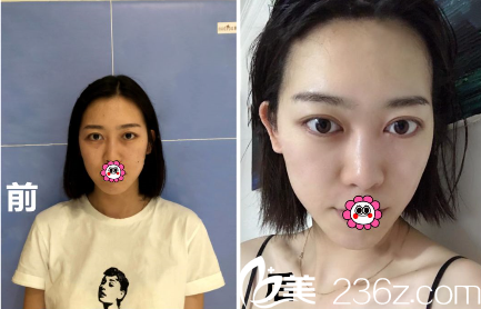 貴州利美康美膚案例效果對比