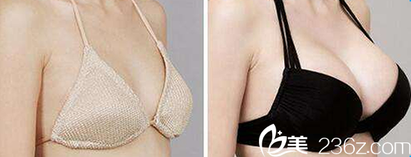 李烈醫(yī)生自體脂肪隆胸效果案例