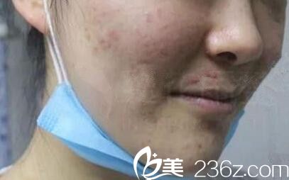 滿臉痘痘痤瘡的樣子 滿臉痘痘痤瘡的樣子