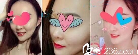 鄭州梨花雨做激光祛痘嫩膚案例 鄭州梨花雨做激光祛痘嫩膚案例