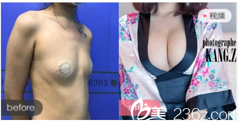 珠海艾瑞整形醫(yī)院祝小偉做的隆胸<span style=