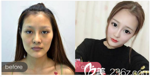 珠海艾瑞整形醫(yī)院熊學(xué)俊做的自體脂肪填充<span style=