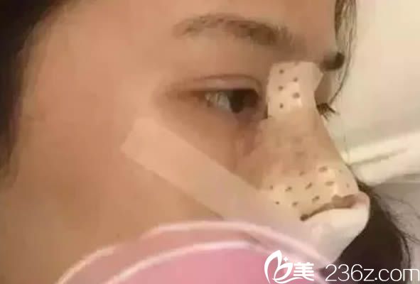 做完海鷗美鼻的術(shù)后即刻效果