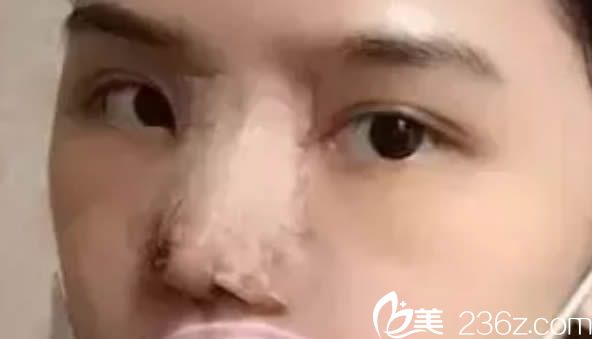 在福州臺江整形醫(yī)院做完隆鼻術(shù)后第4天的樣子