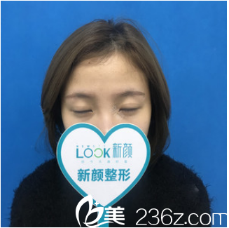 術前單眼皮照片 術前單眼皮照片