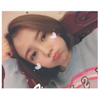 在珠海新顏整形醫(yī)院做完雙眼皮一個月效果 在珠海新顏整形醫(yī)院做完雙眼皮一個月效果