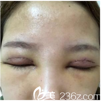 雙眼皮術后兩天 雙眼皮術后兩天
