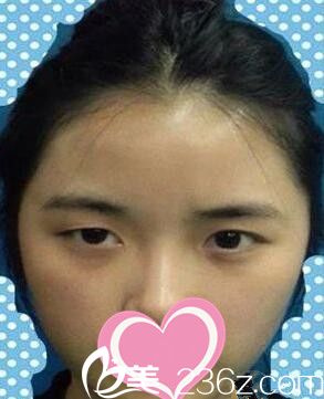 全切雙眼皮+開(kāi)眼角術(shù)前照 全切雙眼皮+開(kāi)眼角術(shù)前照