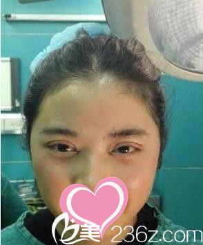 全切雙眼皮+開(kāi)眼角術(shù)后即刻效果 全切雙眼皮+開(kāi)眼角術(shù)后即刻效果