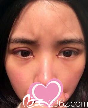 全切雙眼皮+開(kāi)眼角術(shù)后第五天效果 全切雙眼皮+開(kāi)眼角術(shù)后第五天效果