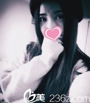 全切雙眼皮+開(kāi)眼角一周拆線后 全切雙眼皮+開(kāi)眼角一周拆線后