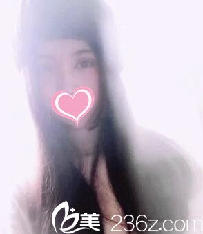 全切雙眼皮+開(kāi)眼角術(shù)后1個(gè)月時(shí)效果 全切雙眼皮+開(kāi)眼角術(shù)后1個(gè)月時(shí)效果