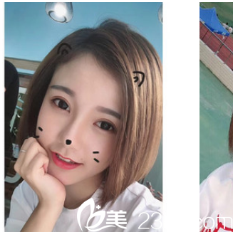 瞧我花1萬多元找珠海新顏整形醫(yī)院醫(yī)生做的全切雙眼皮效果好看嗎