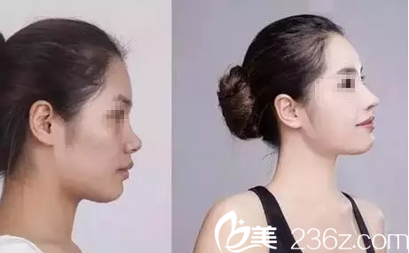 宇芳姬生態(tài)挺俏鼻綜合前后對比