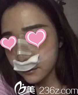 做假體隆鼻術(shù)后天樣子