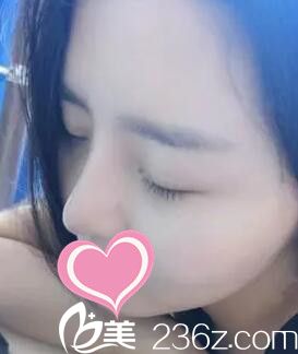 做假體隆鼻術(shù)后半個月<span style=