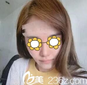 自體脂肪填充面部術(shù)后<span style= 自體脂肪填充面部術(shù)后<span style=