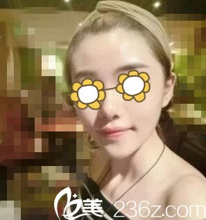 在永州博美做自體脂肪填充全臉術(shù)后一周<span style= 在永州博美做自體脂肪填充全臉術(shù)后一周<span style=