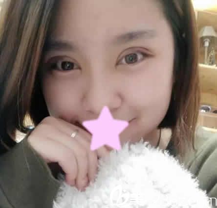 我在運(yùn)城麗都做切開(kāi)雙眼皮修復(fù)和開(kāi)眼角后第7天照片