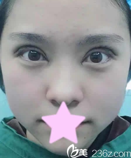 我在運(yùn)城麗都做全切雙眼皮修復(fù)加開(kāi)眼角后第3天照片