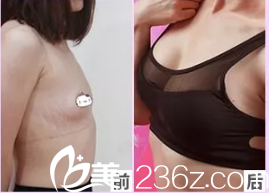 維多利亞隆胸案例 維多利亞隆胸案例