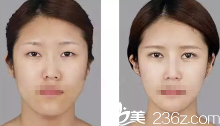 張家口維多利亞雙眼皮案例 張家口維多利亞雙眼皮案例