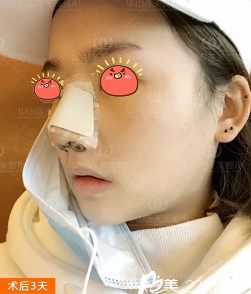 做完肋軟骨隆鼻3天恢復(fù)照