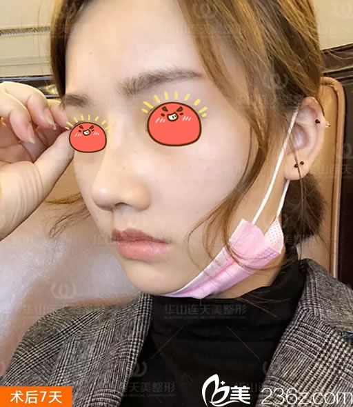 做完肋軟骨鼻綜合隆鼻7天效果圖