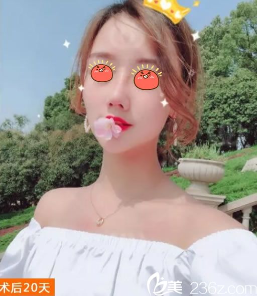 杭州連天美<!--<i data=20240703-sp></i>-->隆鼻案例20天效果