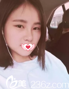 術(shù)后18天雙眼皮、鼻子和面部都在慢慢恢復(fù)中