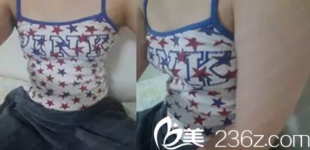 韓國珠兒麗腰腹吸脂+假體隆胸術前照 韓國珠兒麗腰腹吸脂+假體隆胸術前照