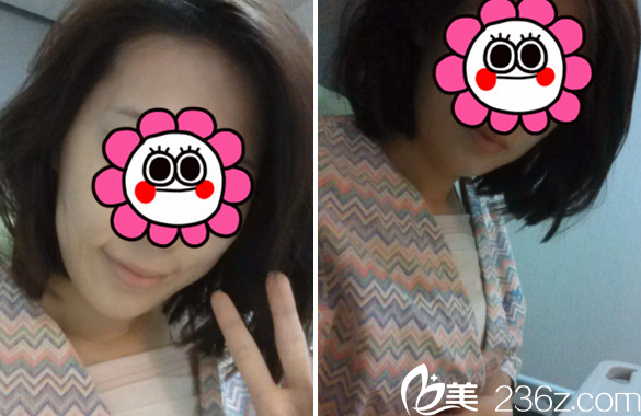 在長(zhǎng)春艾爾莎做假體隆胸手術(shù)后1天 在長(zhǎng)春艾爾莎做假體隆胸手術(shù)后1天