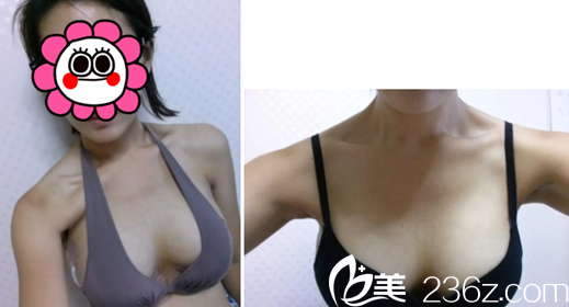 在長(zhǎng)春艾爾莎做假體隆胸手術(shù)后3天 在長(zhǎng)春艾爾莎做假體隆胸手術(shù)后3天