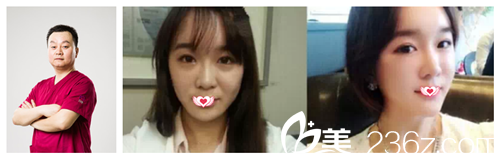 趙彥光醫(yī)生注射玻尿酸案例 趙彥光醫(yī)生注射玻尿酸案例