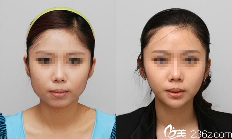 趙彥光主任注射瘦臉案例