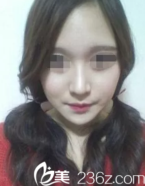 隆鼻手術一個月后