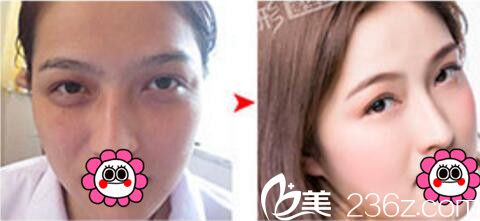 <!--<i data=20240703-sp></i>-->眼部整形之祛眼袋術(shù)真人前后效果對(duì)比 <!--<i data=20240703-sp></i>-->眼部整形之祛眼袋術(shù)真人前后效果對(duì)比