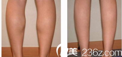 北京華韓諶燃瘦臉除皺瘦腿案例 北京華韓諶燃瘦臉除皺瘦腿案例