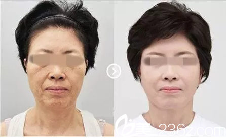 馮院長小帽子除皺抗衰術(shù)效果圖 馮院長小帽子除皺抗衰術(shù)效果圖