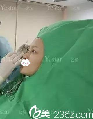 做雙眼皮術(shù)前劃線設(shè)計