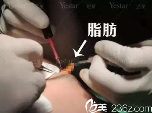 切開法雙眼皮去脂過程