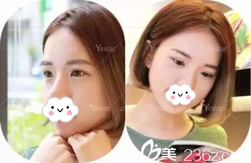 呂永全醫(yī)生切開法雙眼皮術(shù)后恢復(fù)