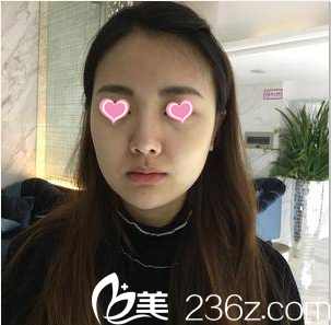 在北京米蘭柏羽麗都注射豐唇前樣子 在北京米蘭柏羽麗都注射豐唇前樣子