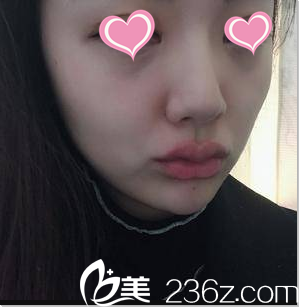 在北京米蘭柏羽麗都注射豐唇當(dāng)天樣子 在北京米蘭柏羽麗都注射豐唇當(dāng)天樣子