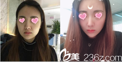 北京米蘭柏羽麗都注射豐唇前后對(duì)比效果 北京米蘭柏羽麗都注射豐唇前后對(duì)比效果