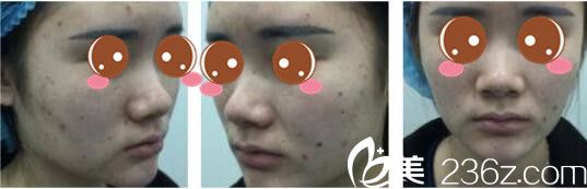 韓國(guó)奧拉克皮膚科整外科樸帝泳鼻綜合真人術(shù)前照案例 韓國(guó)奧拉克皮膚科整外科樸帝泳鼻綜合真人術(shù)前照案例